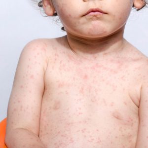 Дети с энтероколитом, вызванным пищевым белком, чаще страдают от аллергий