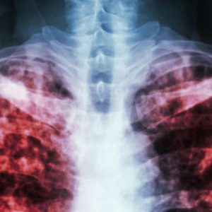 ВОЗ: коронавирус не должен отвлекать от туберкулеза 