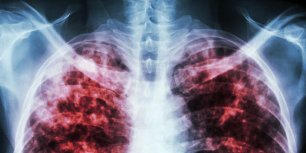 ВОЗ: коронавирус не должен отвлекать от туберкулеза 