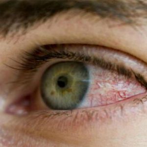 Коронавирус выявлен в слезной жидкости и конъюнктиве глаза