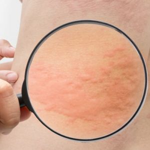 Новый симптом коронавируса: он может вызвать сыпь на коже, похожую на крапивницу