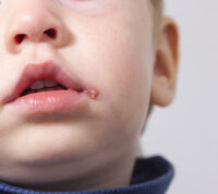 Герпес у дитини: чим лікувати застуду на губах