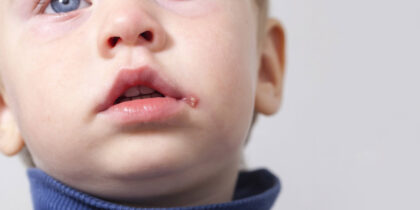 Герпес у дитини: чим лікувати застуду на губах