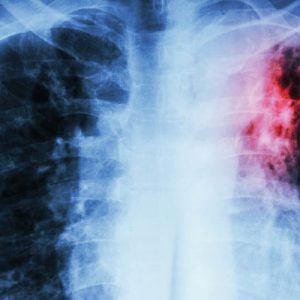 Выявили два новых штамма туберкулеза: чем они опасны