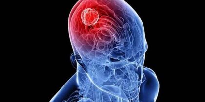 Ученые определили онкоген, вызывающий рак мозга