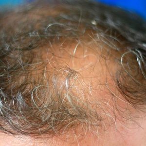 Некоторые больные коронавирусом страдают от выпадения волос