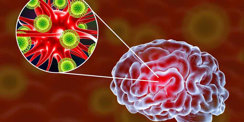 Вирусный менингит и энцефалит: как предотвратить заболевания