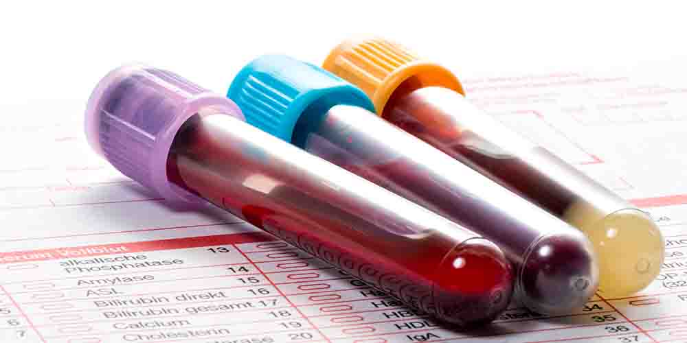 Новый анализ крови прогнозирует тяжесть протекания заболевания Covid-19