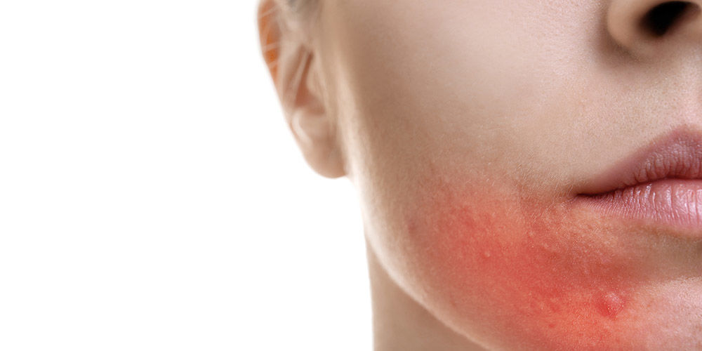 Высыпания на лице могут быть связаны с особым функционированием кожи