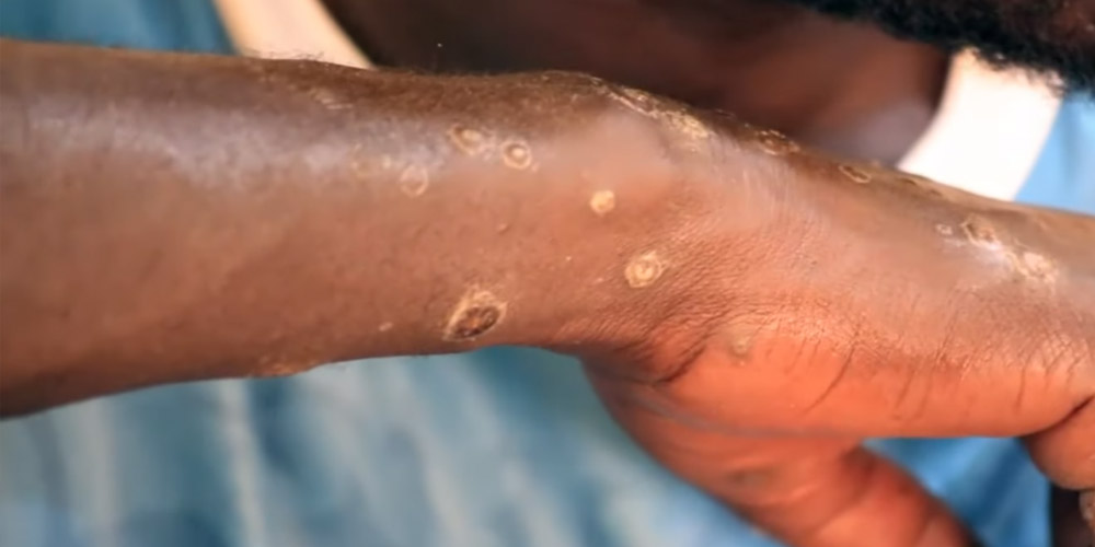 В Сенегале сотни пострадавших от неизвестной болезни