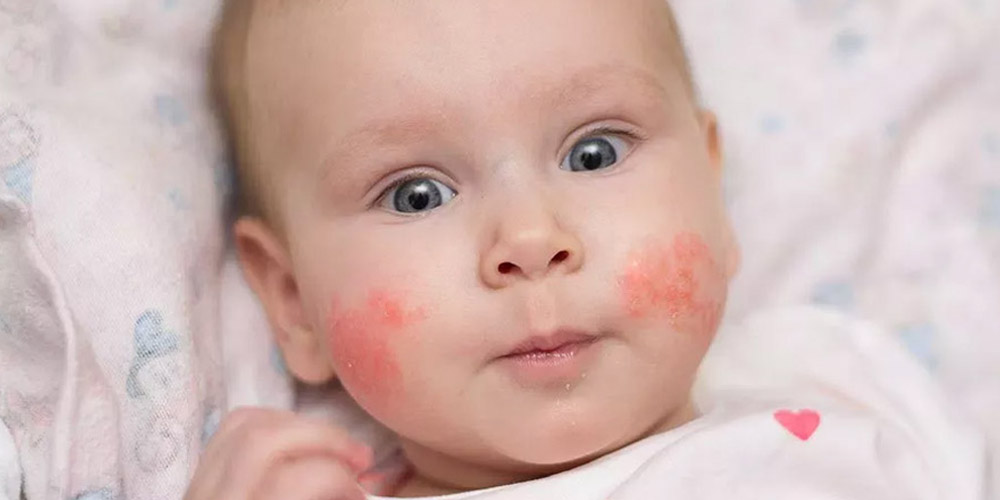 Согласно исследованию, мать может передать предрасположенность к аллергиям ребенку