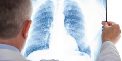 Як перебігає грип у хворих з хронічними обструктивними захворюваннями легень