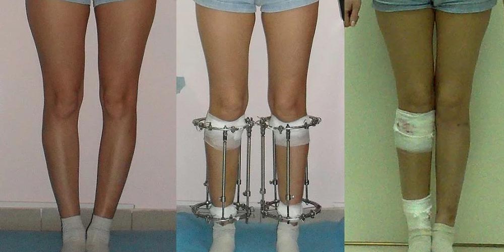 Каждый год сотни людей делают болезненную операцию по вытягиванию ног, чтобы стать на несколько сантиметров выше