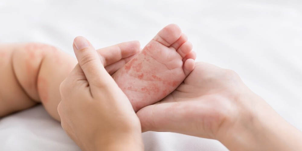 Что общего у пищевой аллергии и детского крема для кожи
