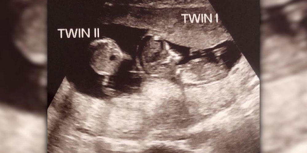 В США женщина забеременела вторым ребенком, вынашивая первого