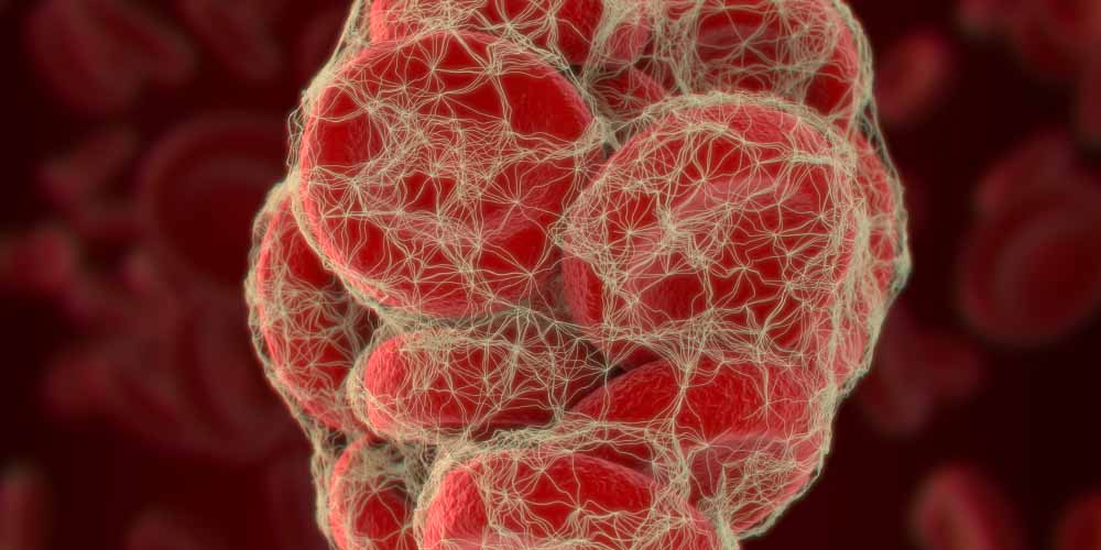 Исследователи ошиблись, но открыли новый многообещающий метод лечения опасного тромбоза