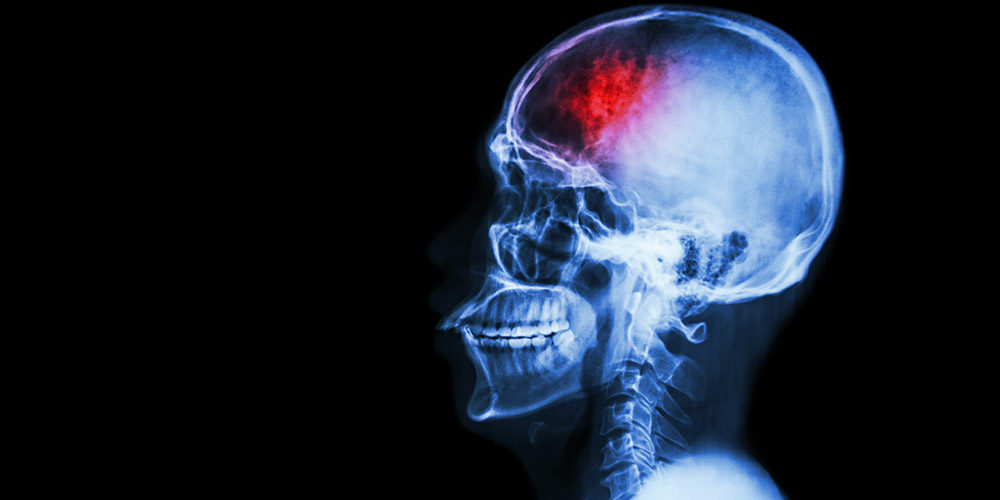Черепно-мозговые травмы могут приводить к инсультам в течении пяти лет