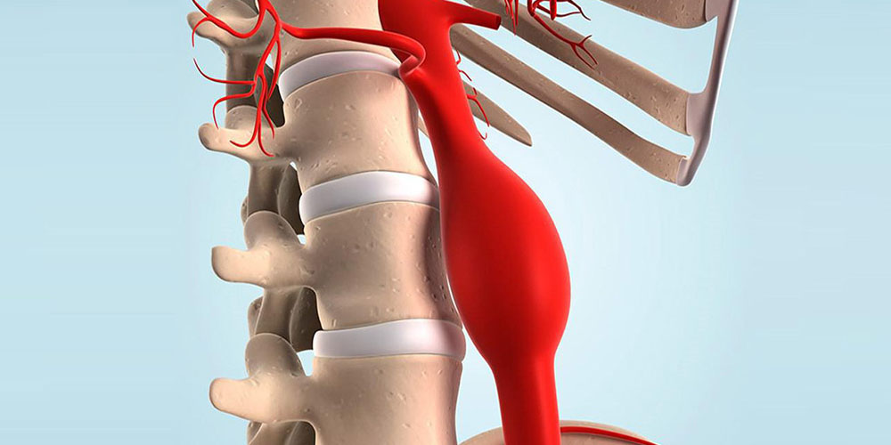 Ученые рассказали, как можно заподозрить у себя аневризму аорты