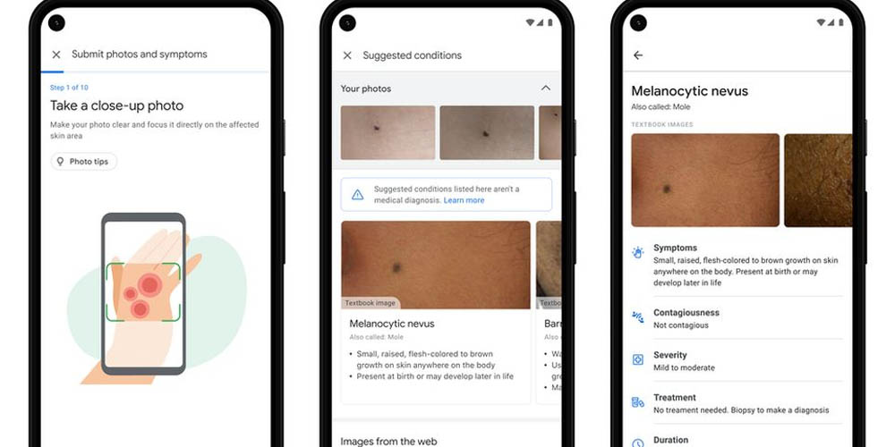 Новое приложение Google поможет распознать кожные заболевания