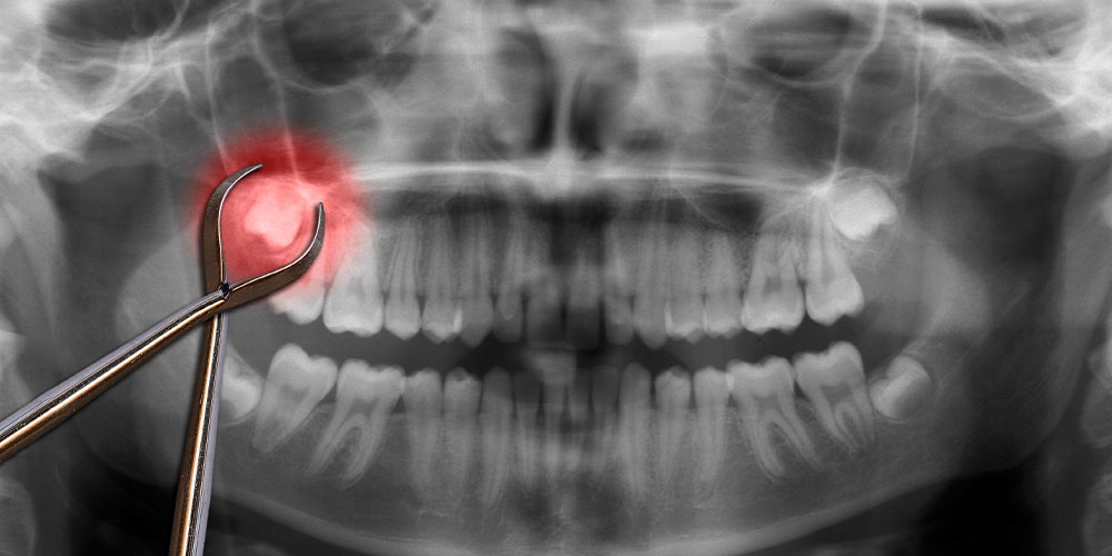 Ученые заявили о преимуществе удаления зубов мудрости