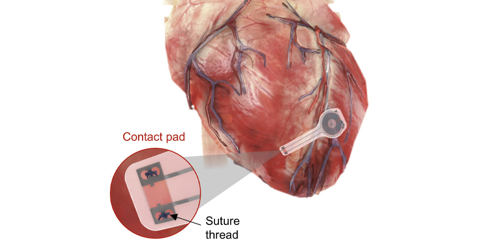 Создан кардиостимулятор, который способен растворяться в организме