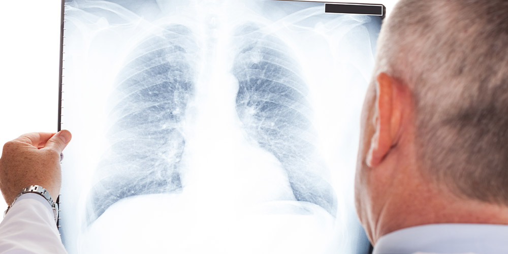 Ученым удалось сократить курс лечения туберкулеза