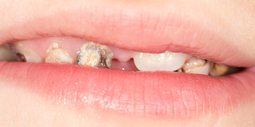 Определили очередные проблемы, которые возникают на фоне плохих зубов