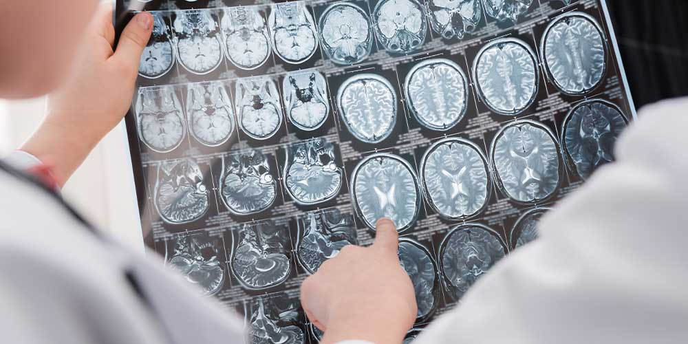 Воспаление мозга при COVID-19 похоже на болезнь Альцгеймера