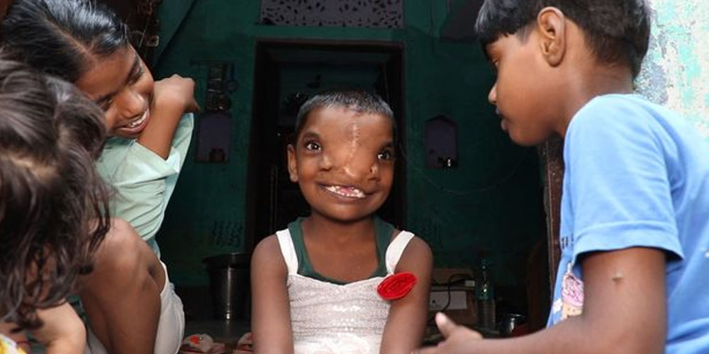 В Индии девочка родилась с хоботом, теперь ее считают богом