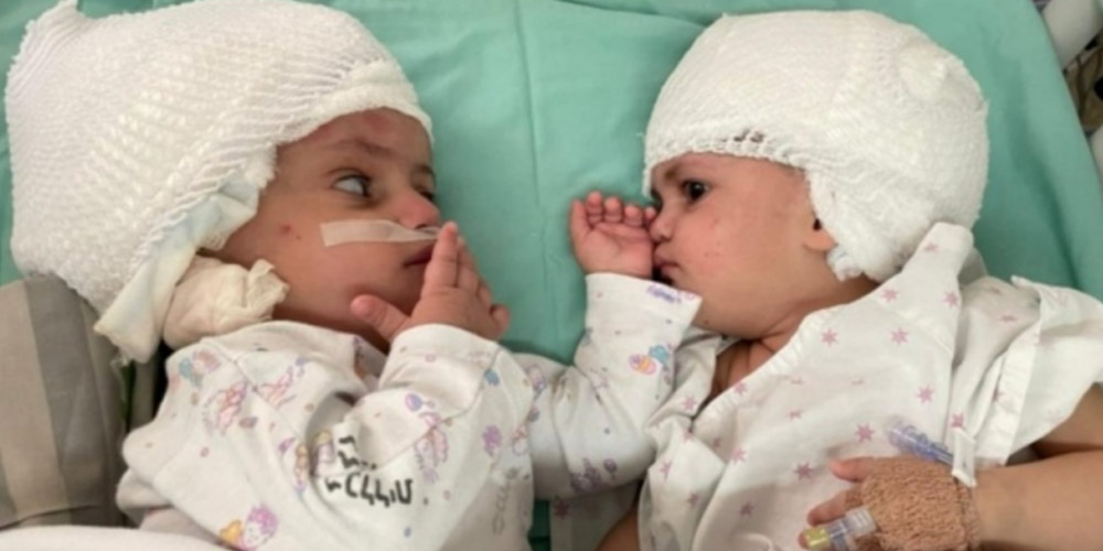 В Израиле разделили сиамских близнецов, срощенных затылками