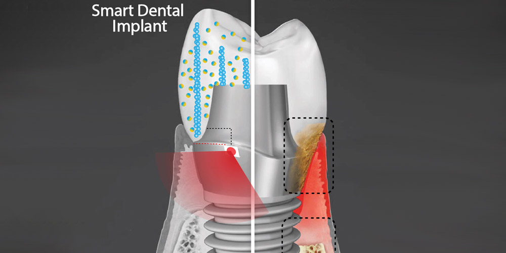 Ученые создают «умный» зубной имплант