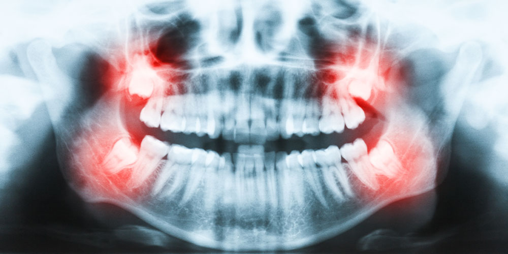 Ученые наконец узнали, почему зубы мудрости появляются уже во взрослом возрасте