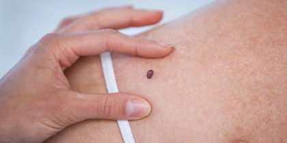 Вскоре возможно появление вакцина от рака кожи