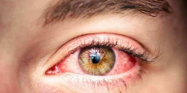 Новый способ обещает успешное лечение синдрома сухого глаза