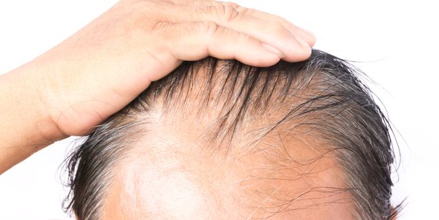 Выпадение волос происходит по четко определенной схеме: что такое облысение по мужскому типу