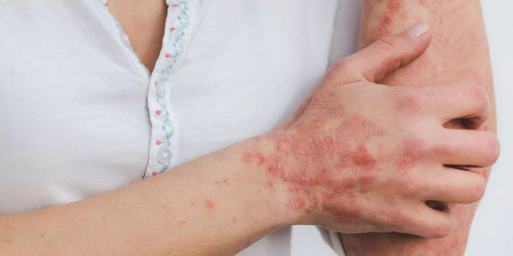 Ученые выяснили, что желчные кислоты могут уменьшить воспаление кожи у пациентов с псориазом